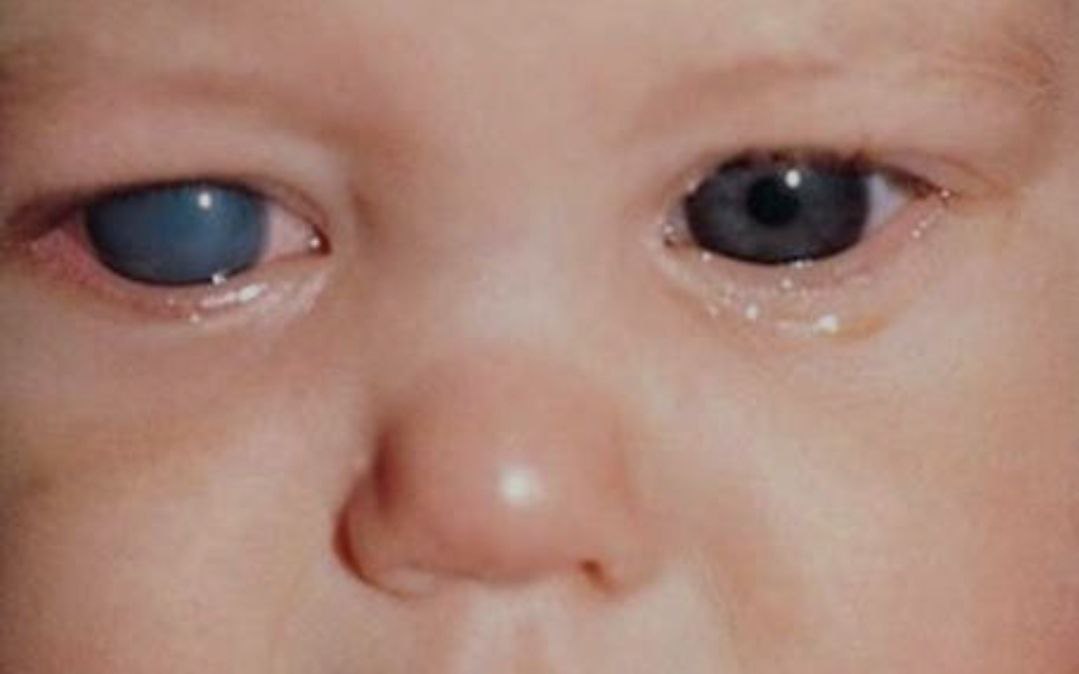 مقالة علمية للمعيدة زينب احمد عباس بعنوان (الماء الأسود لدى الأطفال).