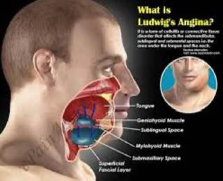 Ludwig’s Angina: A Life-Threatening Soft Tissue Infection