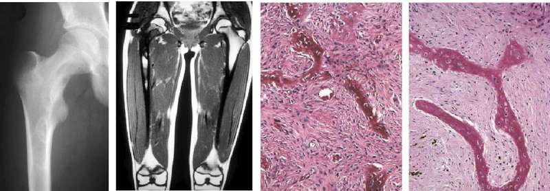 مقالة علمية للاستاذ الدكتور ( منى صالح مرزة ) بعنوان ( Fibrous Dysplasia and Pregnancy)