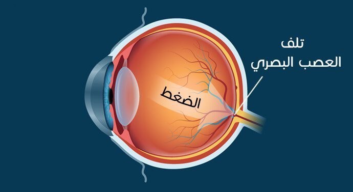 مقالة علمية للتدريسي م.م. حسن عبد الهادي الجابري بعنوان ((العلاجات الجينية لمرض الكلوكوما))