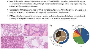 مقالة علمية للاستاذ الدكتور ( منى صالح مرزة ) بعنوان ( Mucinous Adenocarcinoma)