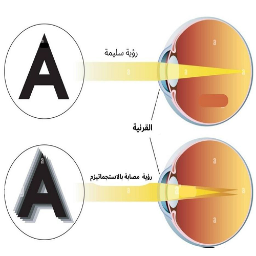 الاستجماتيزم عند الأطفال