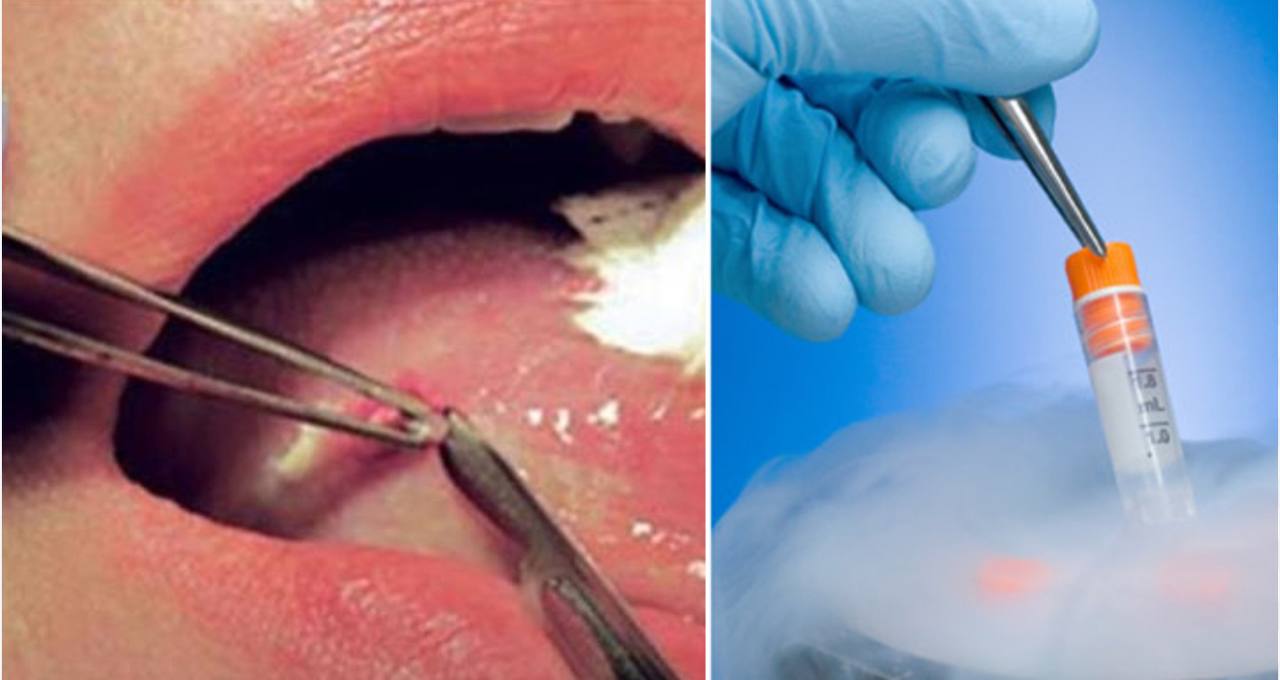 مقالة علمية للسيدة ( د. نور مهند عباس ) بعنوان ( Oral biopsy )