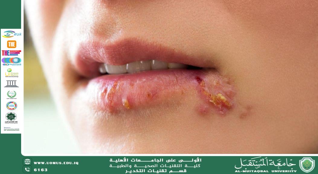 الهربس: ما هو وأسبابه وأعراضه وعلاجه