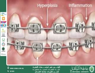 Orthodontics and Gum Health: The Connection Between Braces and Periodontal Care