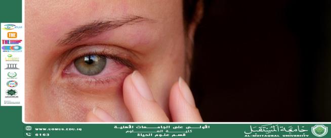 مقالة علمية للتدريسية ( م.م زهراء جواد كاظم ) بعنوان " التهابات العين "