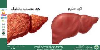 التليف: الأسباب والأعراض والعلاج