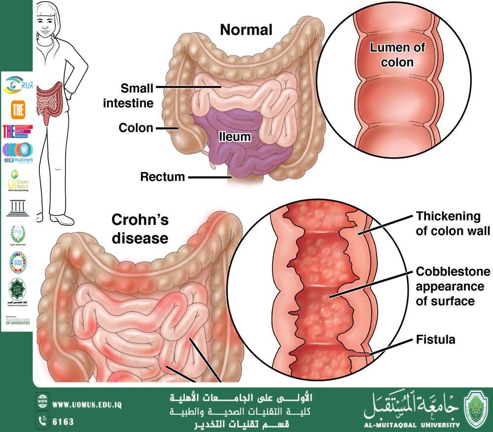 Crohn's disease