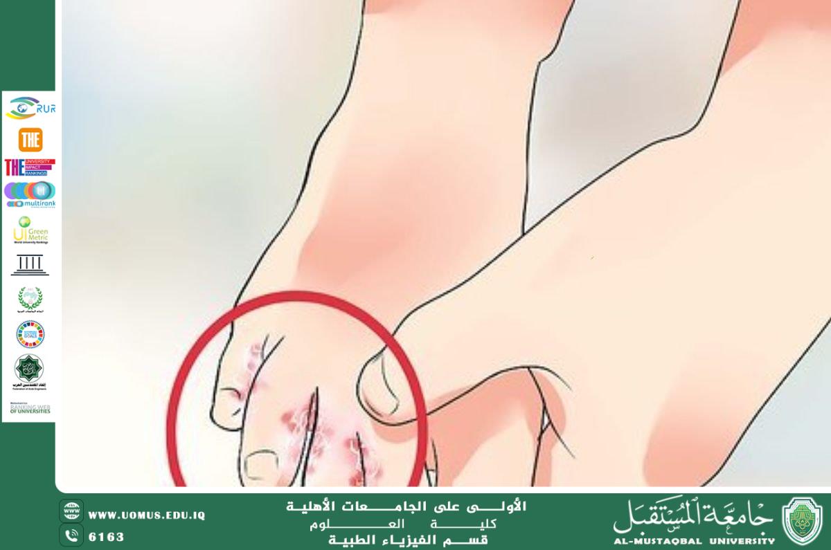 **Athlete's Foot**   By Assistant Lecturer Maryam Latif Shandal