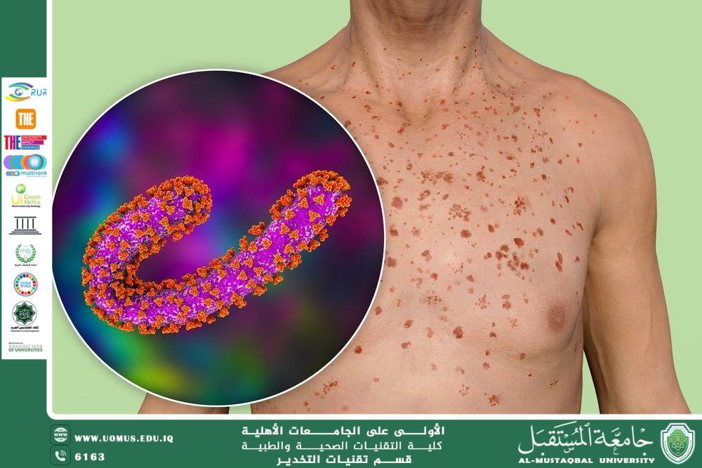 "الحمى النزفية الفيروسية: هل اللحوم الحمراء هي السبب الخفي؟ طرق الانتقال، الأعراض، والوقاية"