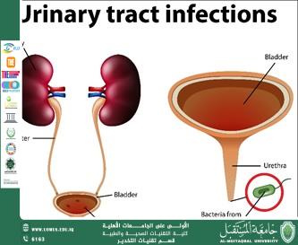 Urinary tract infections in children, causes and management