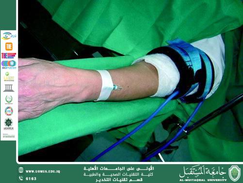 Bier’s Block (Intravenous Regional Anesthesia - IVRA)