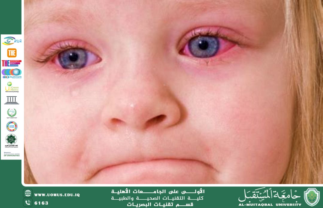 مقالة علمية للمعيدة زينب احمد عباس بعنوان(أمراض العيون: الأسباب والأعراض وطرق الوقاية). 