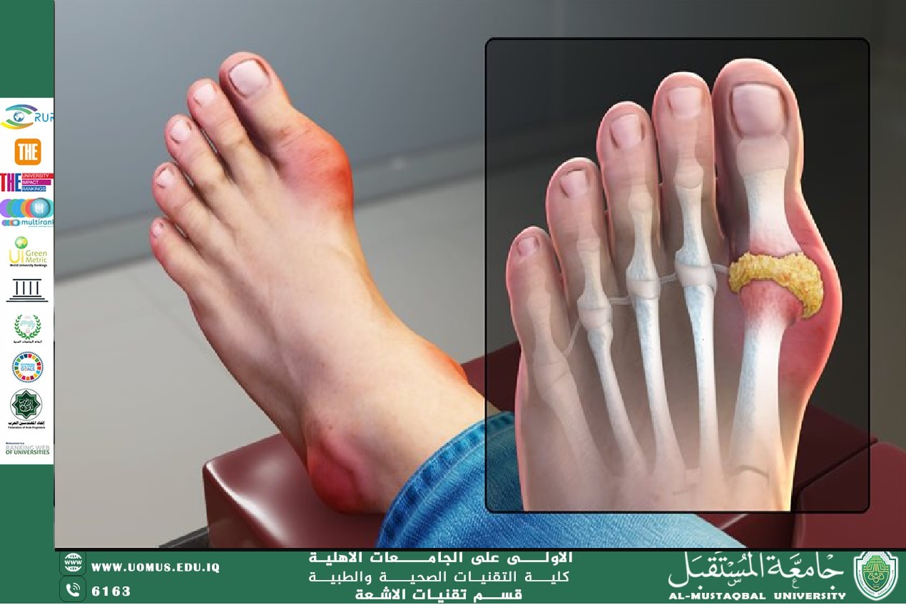 مقالة بعنوان " داء النقرس " بقلم الدكتور الاختصاص زيد سعد عبد ماضي 