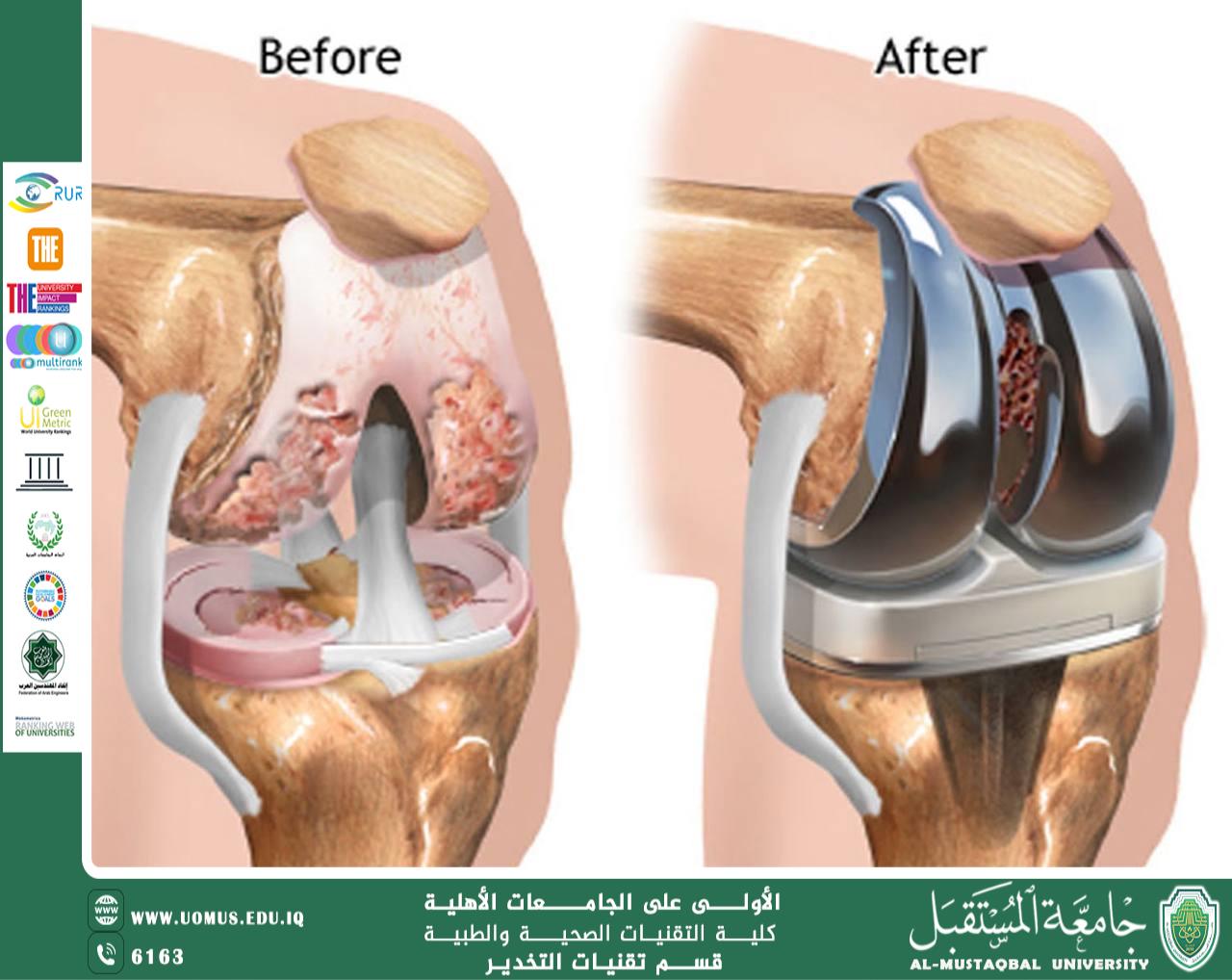 جراحة استبدال المفاصل: كيف تغير حياة المرضى؟