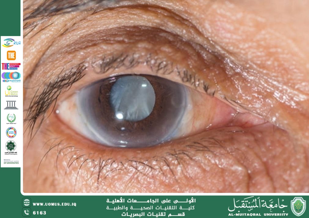 مقالة علمية للتدريسي م.م.مهيمن سمير عارف  بعنوان(  المياه البيضاء: أسبابها وطرق علاجها). 