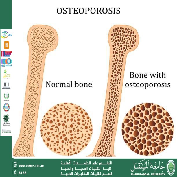 مقالة علمية للسيدة رفيف صفاء هادي بعنوان مرض العظم الزجاجي