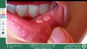 داء بهجت (Behçet's disease)