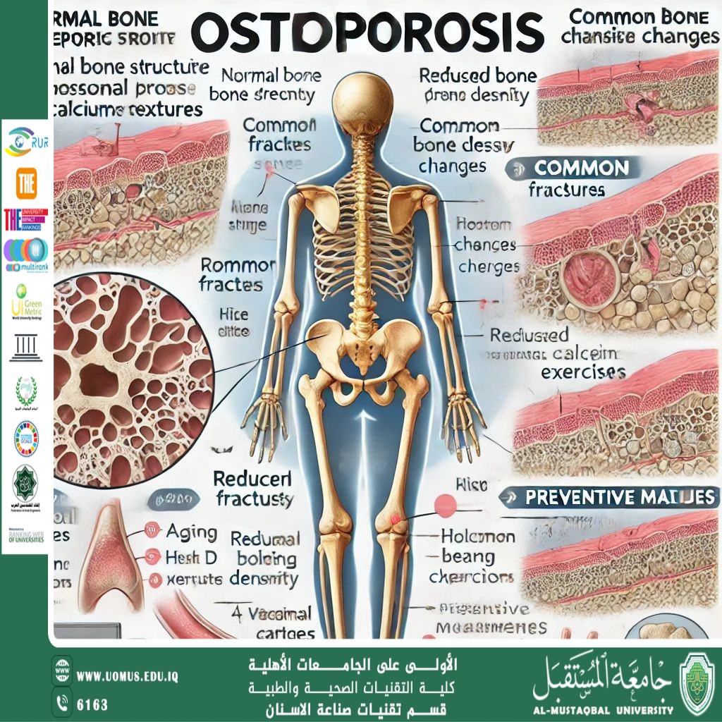  مقالة علمية بعنوان Osteoporosis 