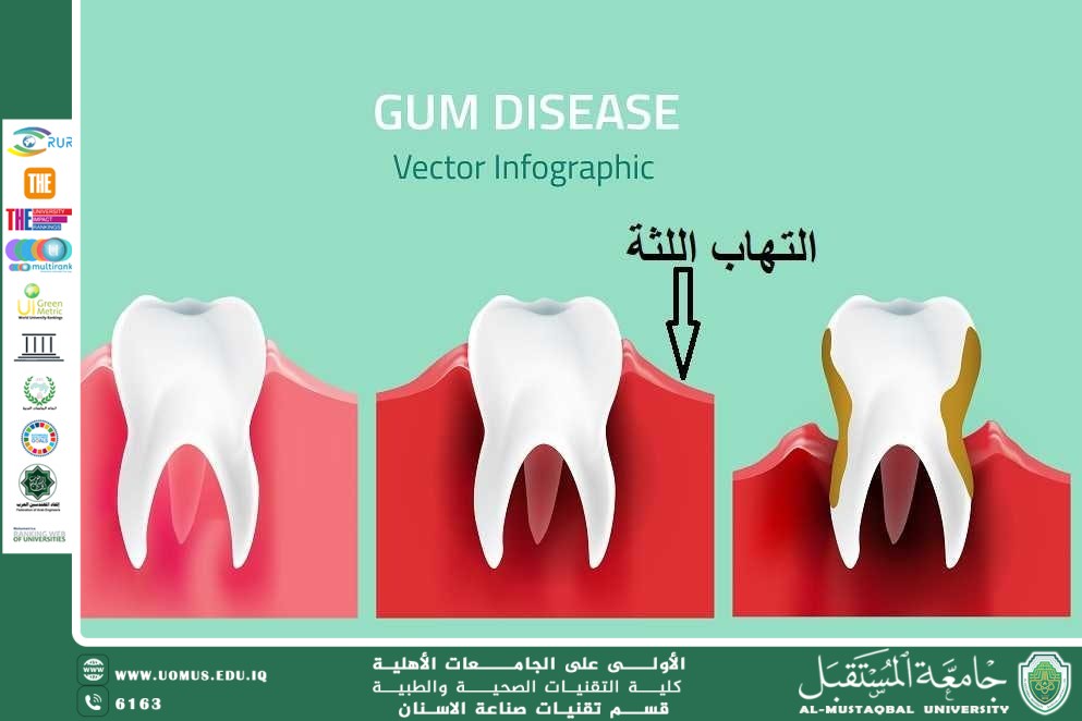التهاب اللثة: أسبابه، أعراضه، وطرق علاجه والوقاية منه