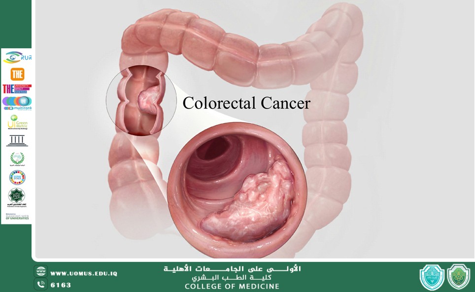 مقالة بعنوان سرطان القولون
