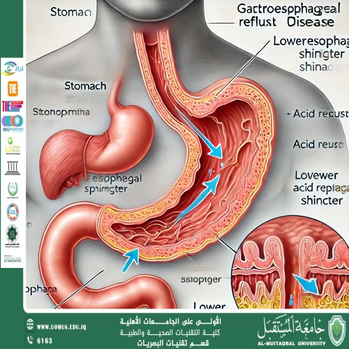 مقالة علمية للمعيدة تمارا نهاد عباس بعنوان (الارتجاع المريئي: الأسباب والأعراض والعلاج)