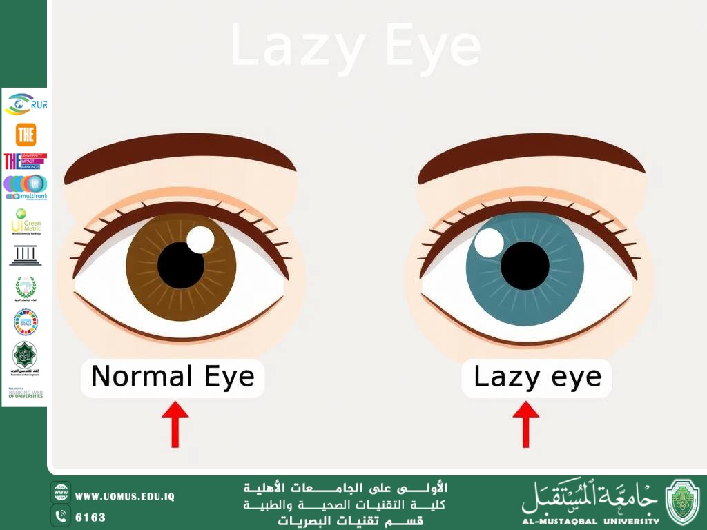 مقالة علمية للمعيدة حنين حيدر حسين بعنوان (كسل العين)