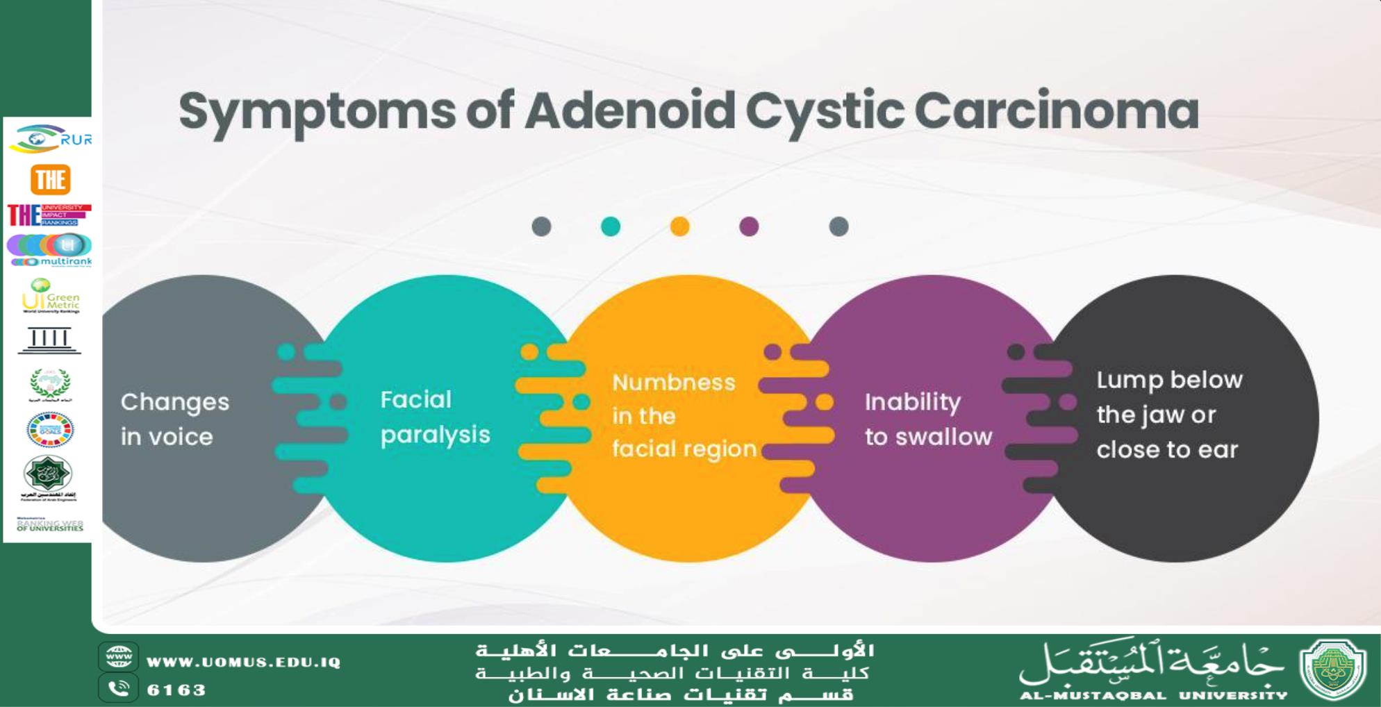 مقالة علمية للاستاذ الدكتور ( منى صالح مرزة ) (( سرطان الغدانية الكيسي وفيروس الورم الحليمي البشري )) 