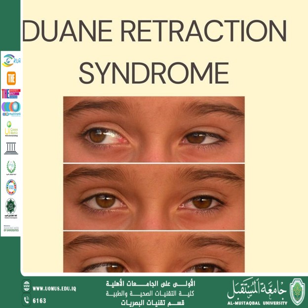 An article by the lecturer Noor  Khamis entitled(What is Duane Syndrome)