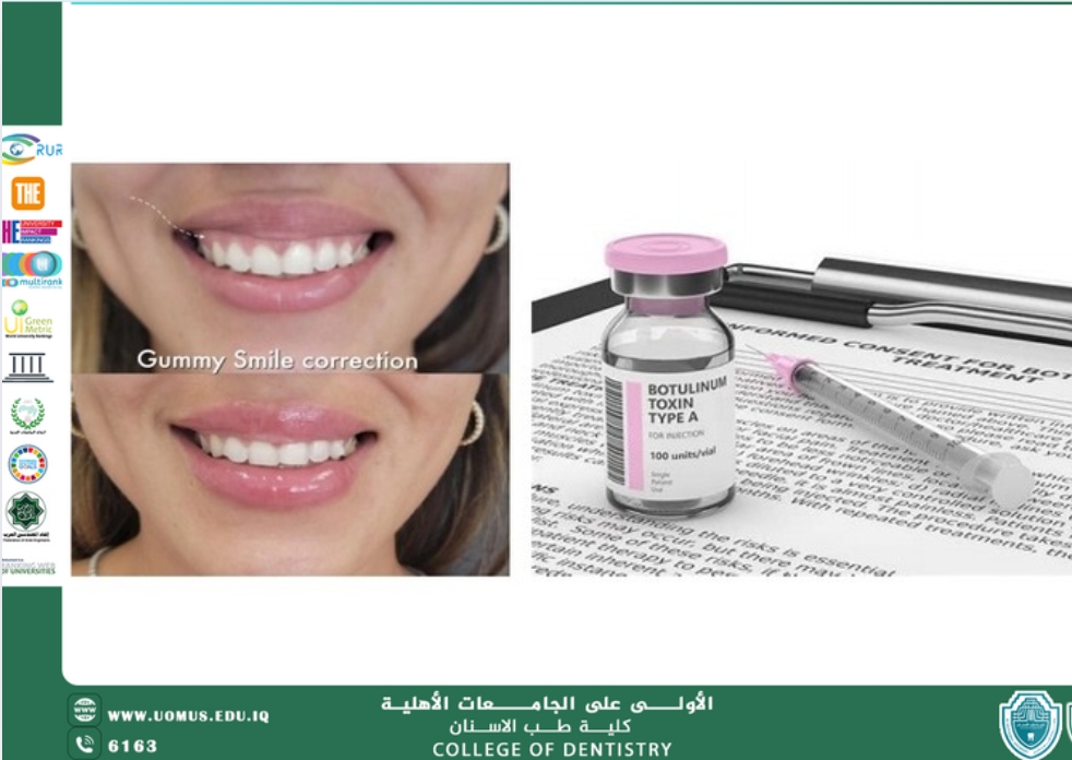 مقالة علمية للدكتورة هنادي هادي بعنوان " البوتكس في طب الأسنان"