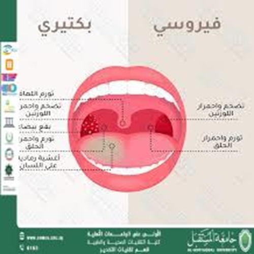 التهاب اللوزتين عند الأطفال