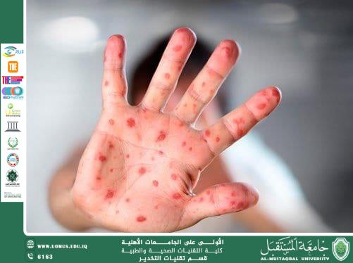 الحمى القلاعية: الأسباب، التشخيص، والعلاج