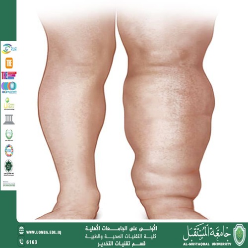 الوذمة اللمفاوية