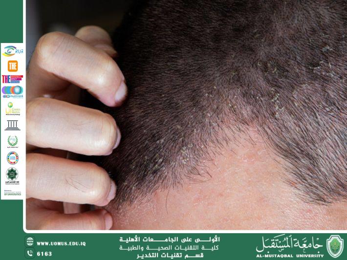 ما هي الأكزيما الدهنية