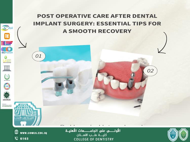 A New Scientific Article by Dr. Hussein Hatem Muallah Titled "Post-Surgical Care Following Dental Implant Surgery"