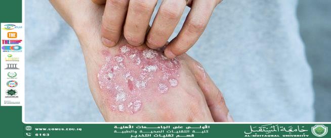 مقالة     الصدفية Psoriasis