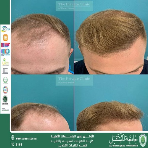 زراعة الشعر