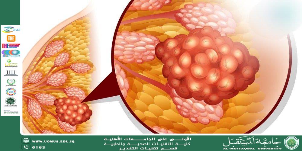 سرطان الثدي: الأسباب، التشخيص، والعلاج