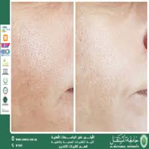 البولي ديوكسي ريبونوكليوتيد (PDRN) لتجديد الشباب: طفرة في الطب التجديدي