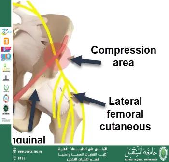 Meralgia parasthetica