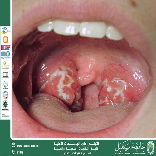 التهاب الحلق الحاد: الأسباب، الأعراض، والتفسير العلمي لصعوبة البلع