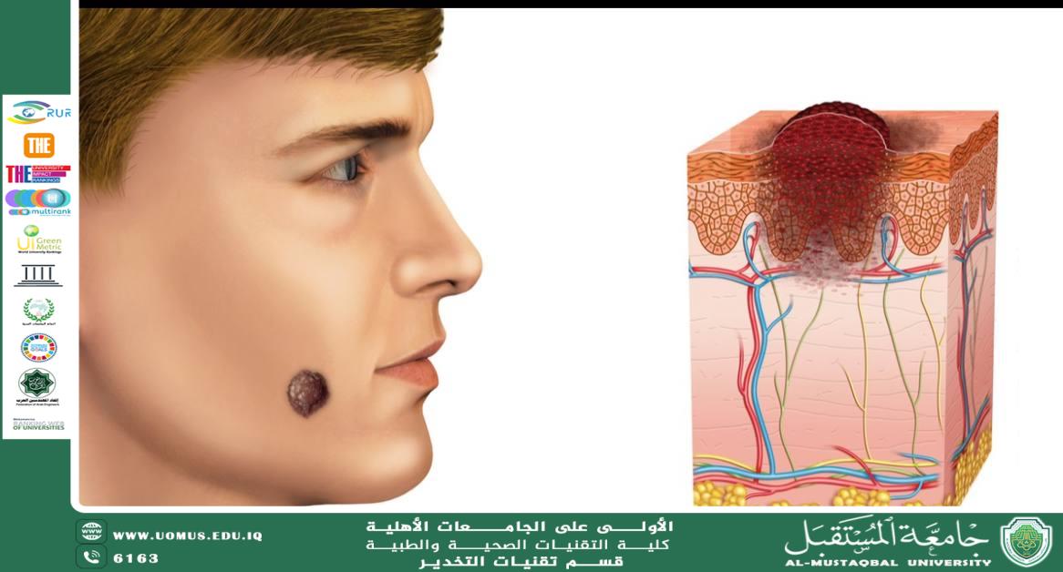 الكشف المبكر عن سرطان الجلد: