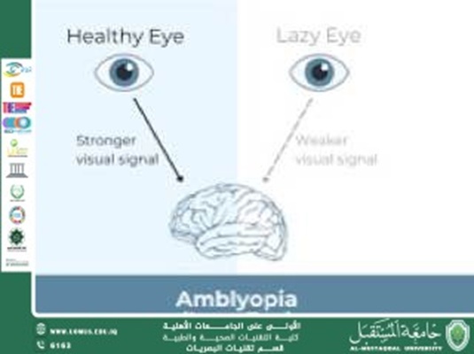 An article by the lecturer Hassan Abd Ali entitled(Amblyopia in Children: Current Understanding and Management)