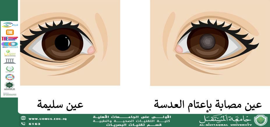 مقالة علمية للدكتور غيث علي محمد بعنوان ( تكثف العدسة البلورية (الماء الأبيض) في العين )