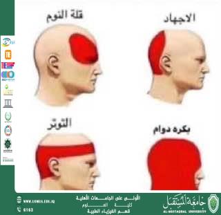 Scientific Article by Assistant Lecturer (Maryam Latif Shandal) Entitled “Migraine: Causes, Symptoms, and Treatment Methods”