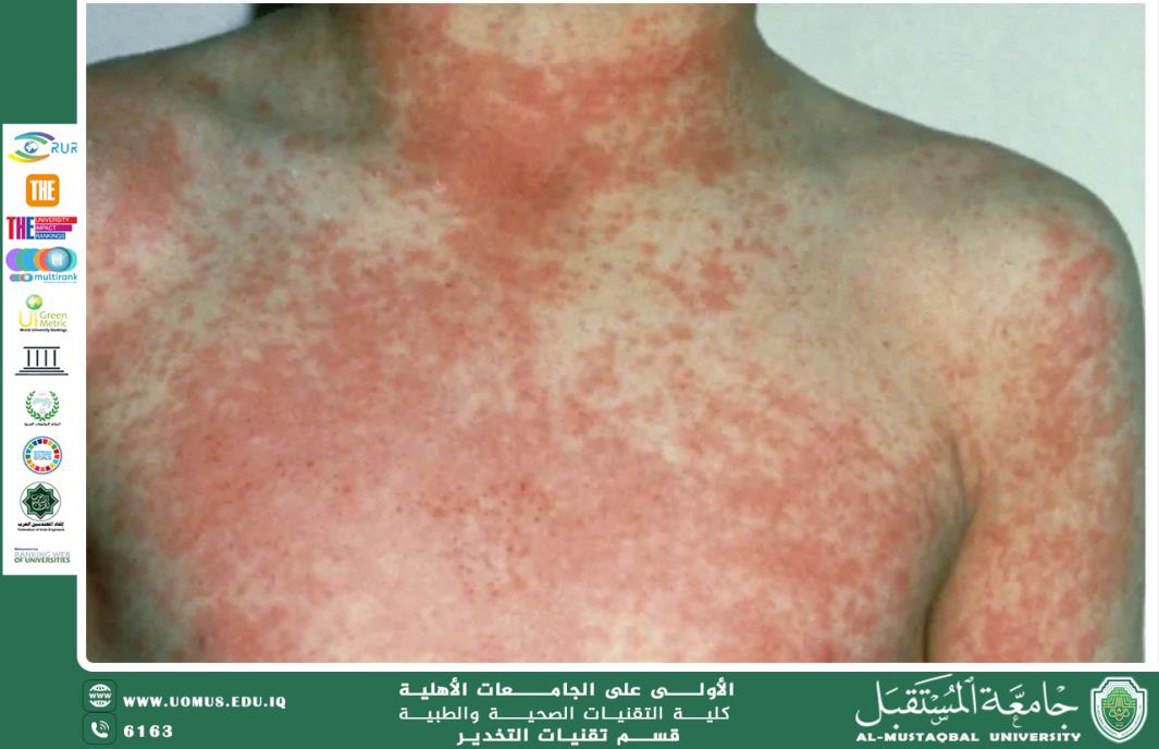 الطفح الجلدي: الأسباب والأعراض والعلاج