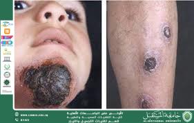 مقالة علمية لرئيس قسم تقنيات التجميل والليزر ( ا.م.د فاطمة هاشم عباس ) بعنوان  (حبة بغداد تحت المجهر: أسرار طفيلي اللشمانيا وآليات انتشاره)