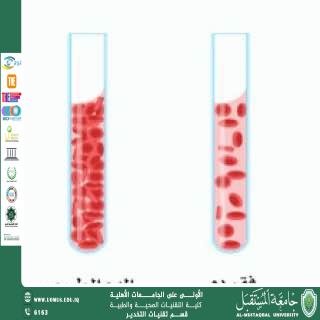 فقر الدم عند النساء: الأسباب والعلاج