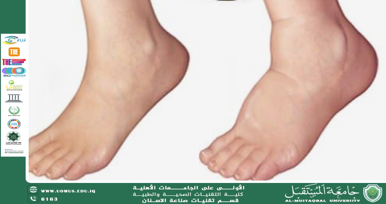 مقاله علمية للدكتوره نور مهند عباس بعنوان oedema