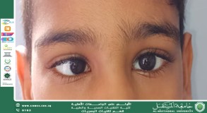 A scientific article DR. Nilofer Ewadh  entitled(congenital esotropia).